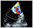 Color Doppler Color Doppler